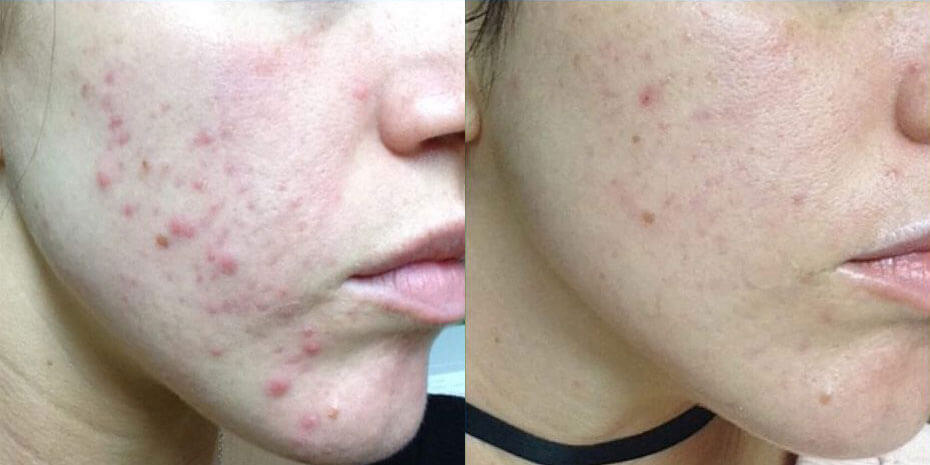 Before and after Acne treatments