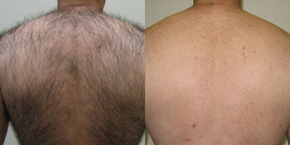 Hair removal before and after treatment