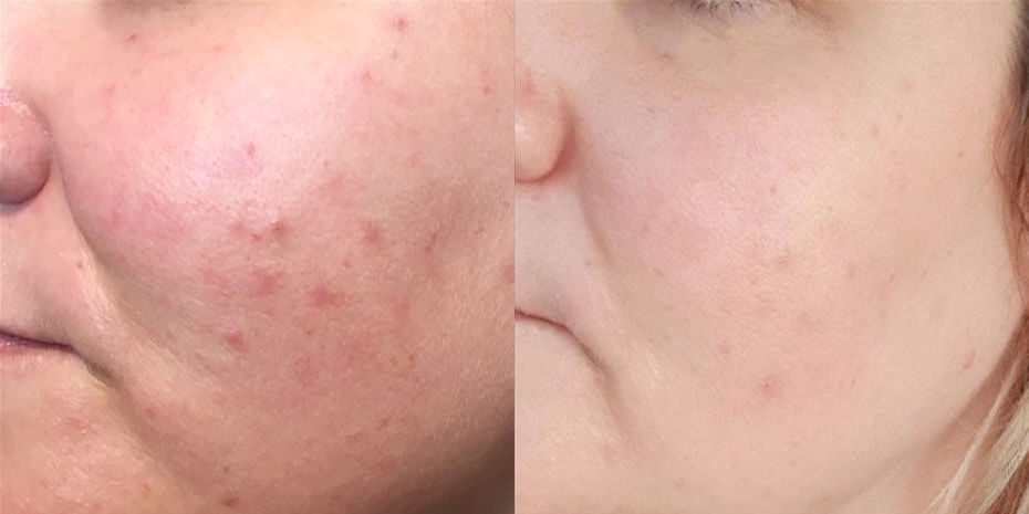 Before and after Illumifacial treatments