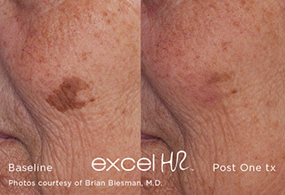 Before and after pigment removal