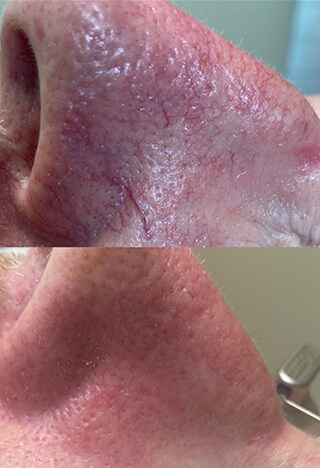 Before and after red veins rosacea treatments